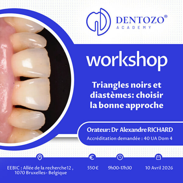 Triangles noirs et diastèmes : choisir la bonne approche